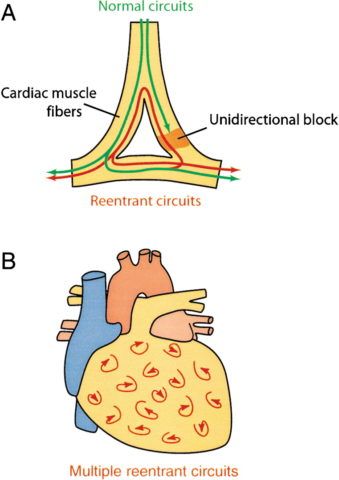 Графическое изображение патогенеза большей части сердечных аритмий.