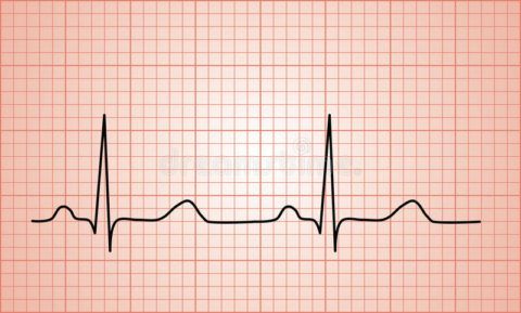 При подозрении на ишемическую болезнь сердца всегда проводится ЭКГ