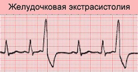 На фото кардиограмма при диагнозе «желудочковая экстрасистола».