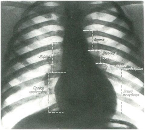 Отделы сердца на рентгене