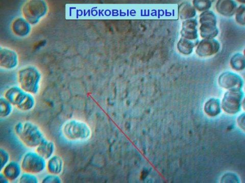 Обнаруженные следы микроскопических грибов при гемосканировании