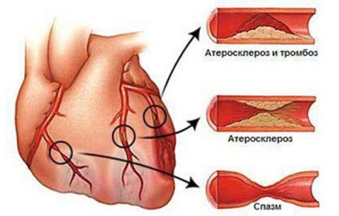 Проблемы коронарных артерий