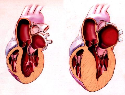 Здоровое сердце и сердце с увеличенной массой левого желудочка
