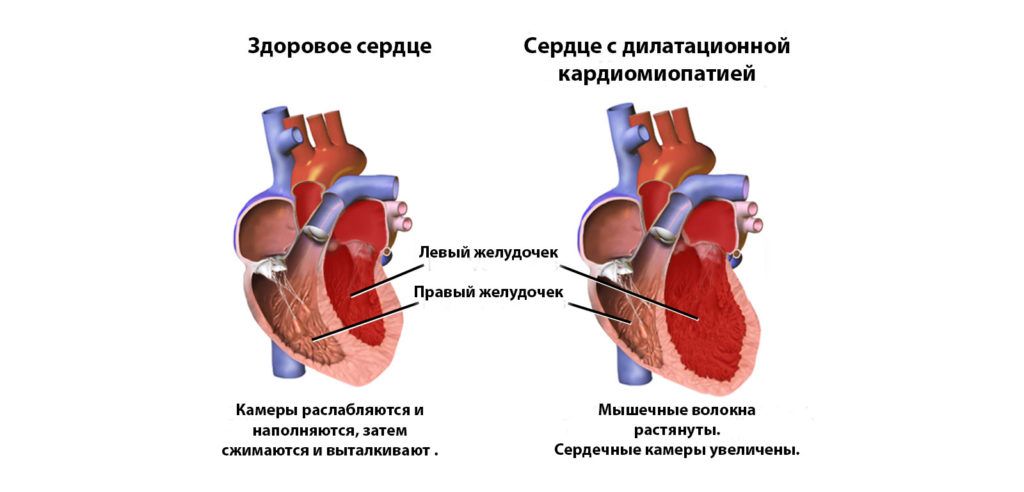 Характеристика дилатационной кардиомиопатии