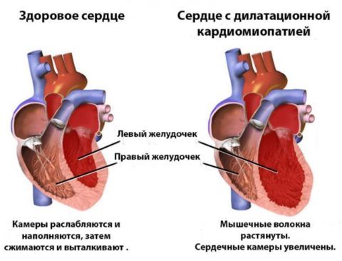 Изменения в сердце при кардиопатии (кардиомиопатии)