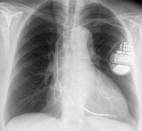 Наличие кардиостимулятора – прямое противопоказание к проведению МРТ