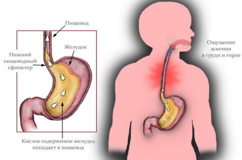 Жжение по центру грудной клетки может вызывать обратный вброс кислоты из желудка в пищевод