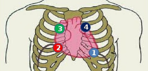 Места прослушивания систолического (1, 2) и диастолического (3, 4) сердечных тонов
