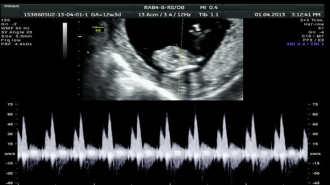 Снимок ультразвукового сканирования практически идеальной работы сердца плода