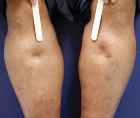 Отек ног — один из симптомов скопления большого количества экссудата в околосердечной сумке